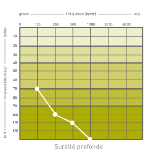 audiogramme profond