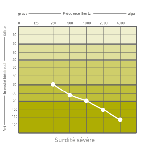 audiogramme severe